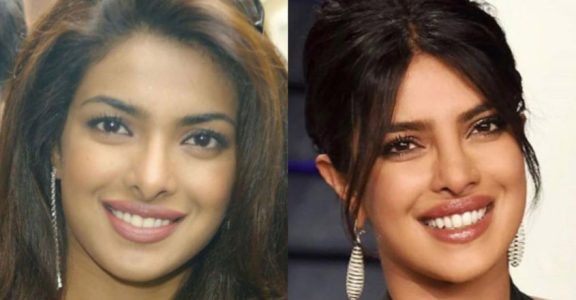 Check out how plastic surgery transformed these actresses